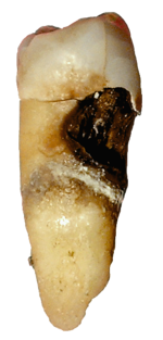 Destruction of enamel by cervical decay from dental caries.