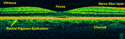 OCT scan of a retina at 800nm with an axial resolution of 3&micro;m