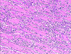 Microscopy image (magn. ca 100x, H&E stain) from autopsy specimen of myocardial infarct (7 days post-infarction).
