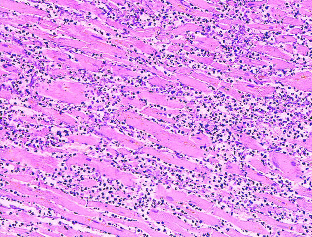 Image:Myocardial infarct emmolition phase histopathology.jpg
