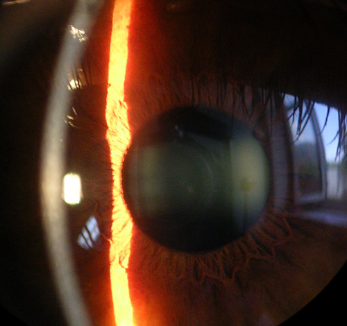 Image:Cornea.jpg