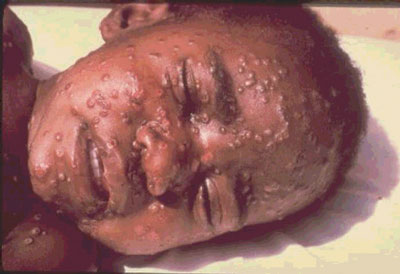 Image:Smallpox.jpg