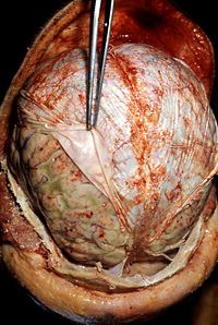 An autopsy demonstrating signs of pneumococcal meningitis. The forceps (center) are retracting the dura mater (white). Underneath the dura mater are the leptomeninges, which are edematous and have multiple small hemorrhagic foci (red).
